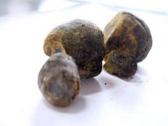 ��Ȼ�Ʒ���ҽ��ô���Ƶ���ʯ